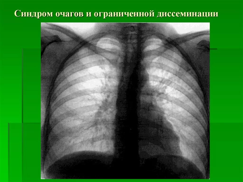 Синдром диффузной. Очаги и ограниченные очаговые диссеминации. диссеминированный синдром рентген. бронхогенная диссеминация рентген. синдром легочной диссеминации рентген.