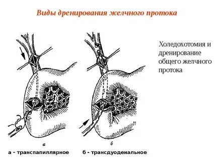 Дренирование протоков