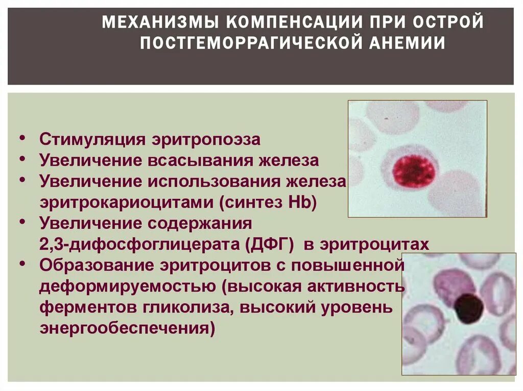 Анемии постгеморрагическая гемолитическая. Механизм острой постгеморрагической анемии. Картина крови при острой постгеморрагической анемии. Механизмы компенсации острой постгеморрагической анемии. Механизмы компенсации при острой постгеморрагической анемии.