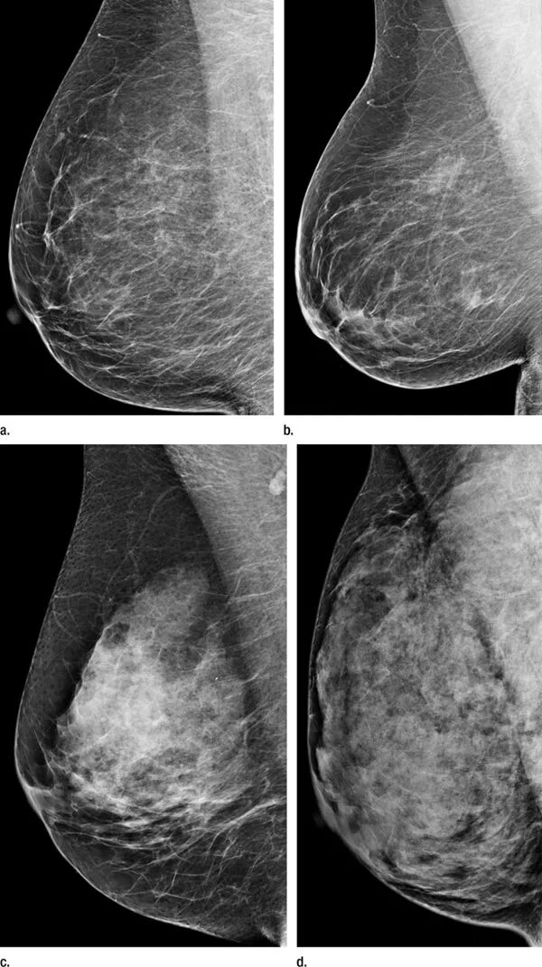 Диффузная мастопатия bi rads 2