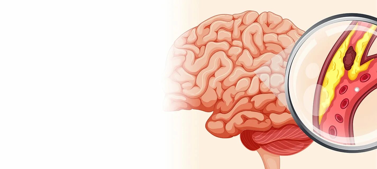Атеросклероз сосудов головного мозга. Атеросклероз артерий головного мозга. Атеросклероз головного мозга рисунок.