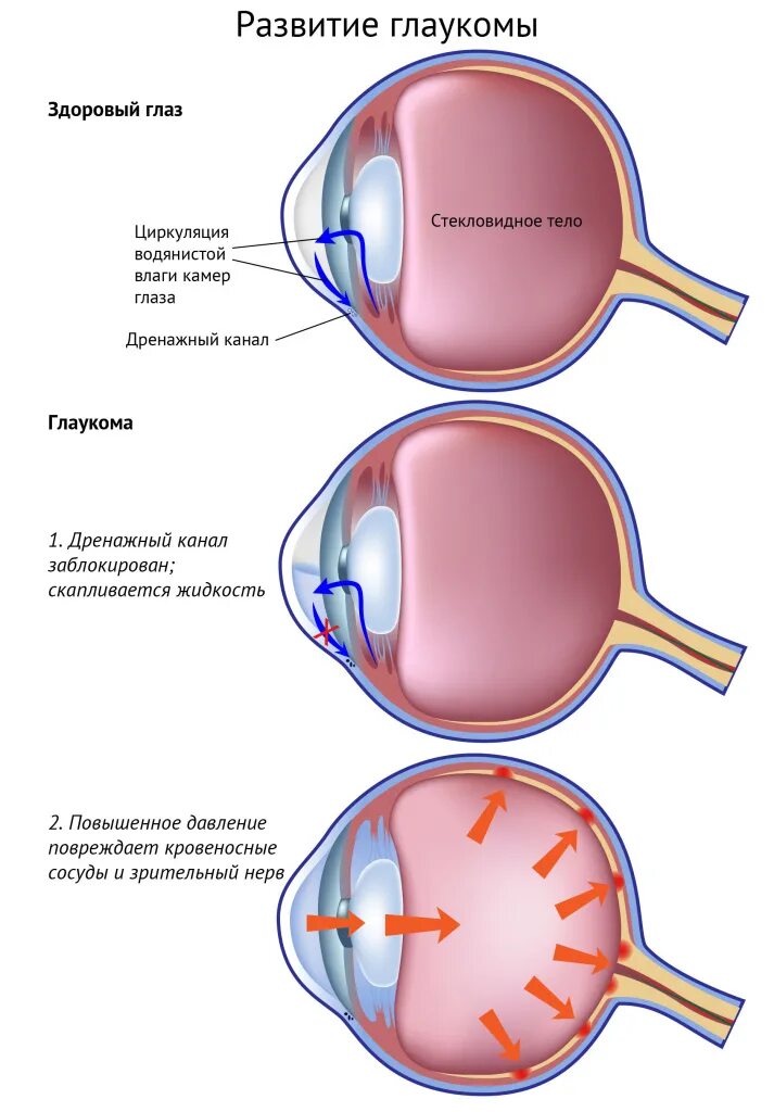 Внутриглазное давление глаукома. Глаукома глазная жидкость.