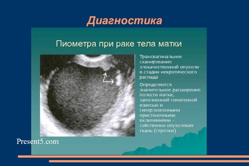 Рак 0 матки. Новообразование в матке на УЗИ. Рпкмшейки матки на УЗИ.