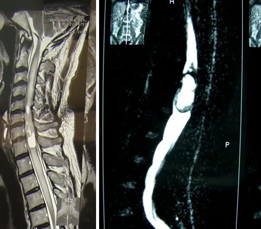 Эпендимома спинного мозга. Глиома спинного мозга мрт. Метастатические опухоли спинного мозга.
