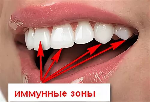Иммунные зоны. Иммунные зоны зуба располагаются. Иммунные зоны зуба это в стоматологии. Иммунные поверхности зубов.