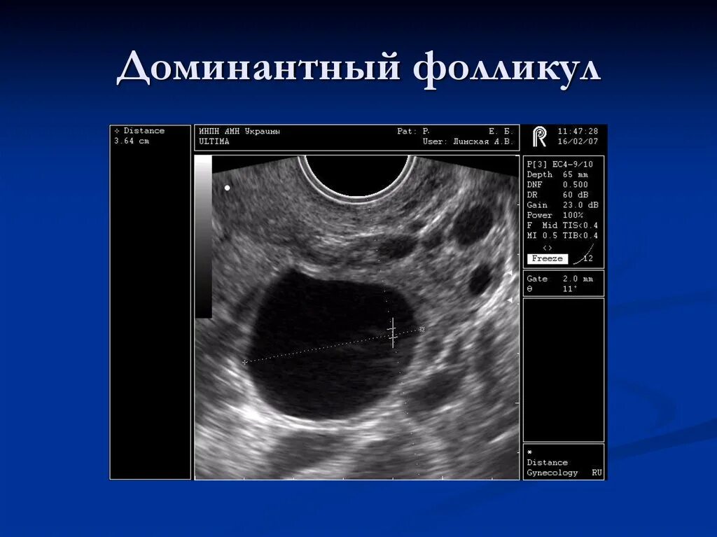 Доминантный фолликул на УЗИ. Персистирующий фолликул на УЗИ. УЗИ яичников доминантный фолликул. Находится в фолликуле