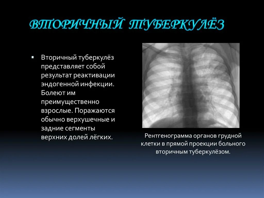 Начальная стадия туберкулеза у взрослых. Формы вторичного туберкулеза легких. Вторичный туберкулез легких.