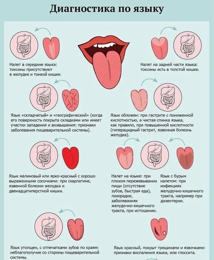 Что означает розовый язык. Болезни по языку схема. Нормальный белый налет на языке.