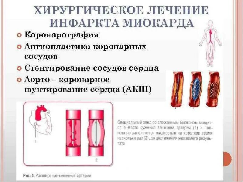 Какие лекарства после стентирования сердца. Операция при инфаркте миокарда стентирование. стентирование сосудов сердца при инфаркте миокарда. хирургическое лечение инфаркта миокарда показания противопоказания. хирургический метод лечения инфаркта миокарда:.