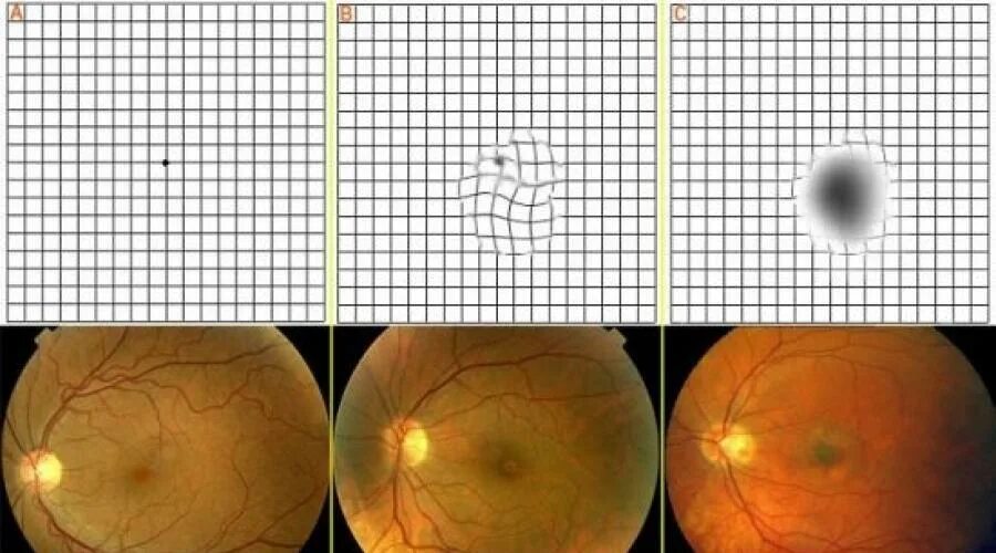 Макулярная дистрофия сетчатки. Макулярная отслойка сетчатки. Возрастная макулодистрофия сетчатки. Макулодистрофия, макулярная дегенерация; ретинит;. Тест сетчатки глаза