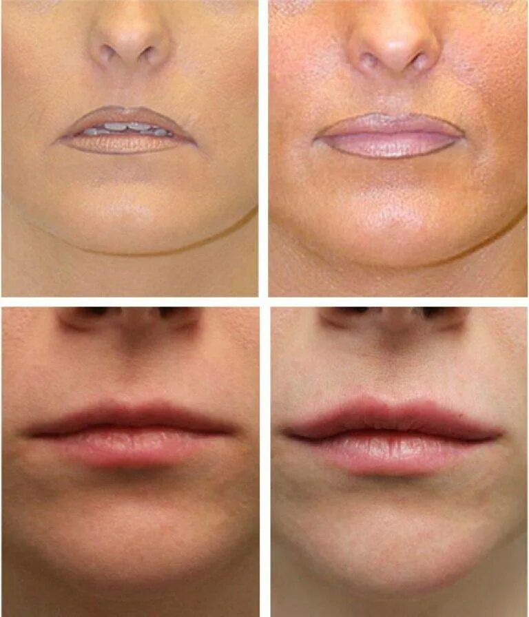 Контур до после. Контур до после. Неудачный перманентный ма3ияж шуб. Контур до после. Татуаж губ с четким контуром.