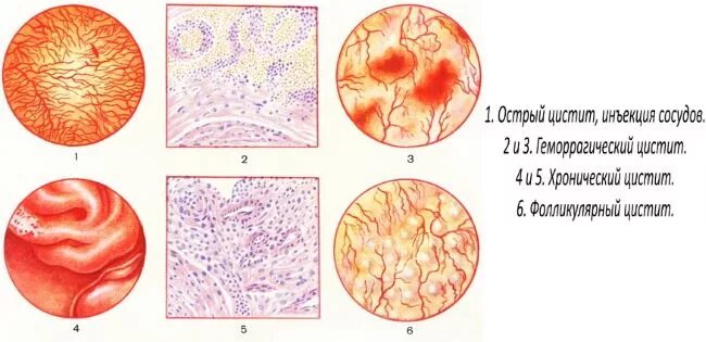 Хронический катаральный цистит. Острый катаральный цистит. Буллезный цистит патанатомия. Простатоцистит