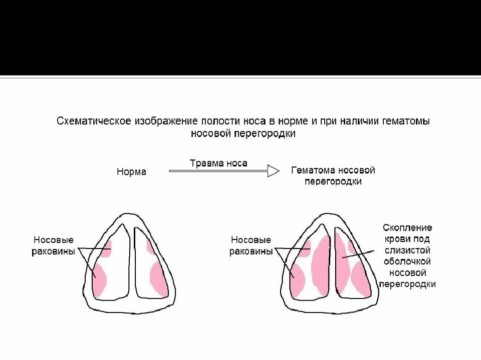 Абсцесс перегородки: найдено 88 картинок