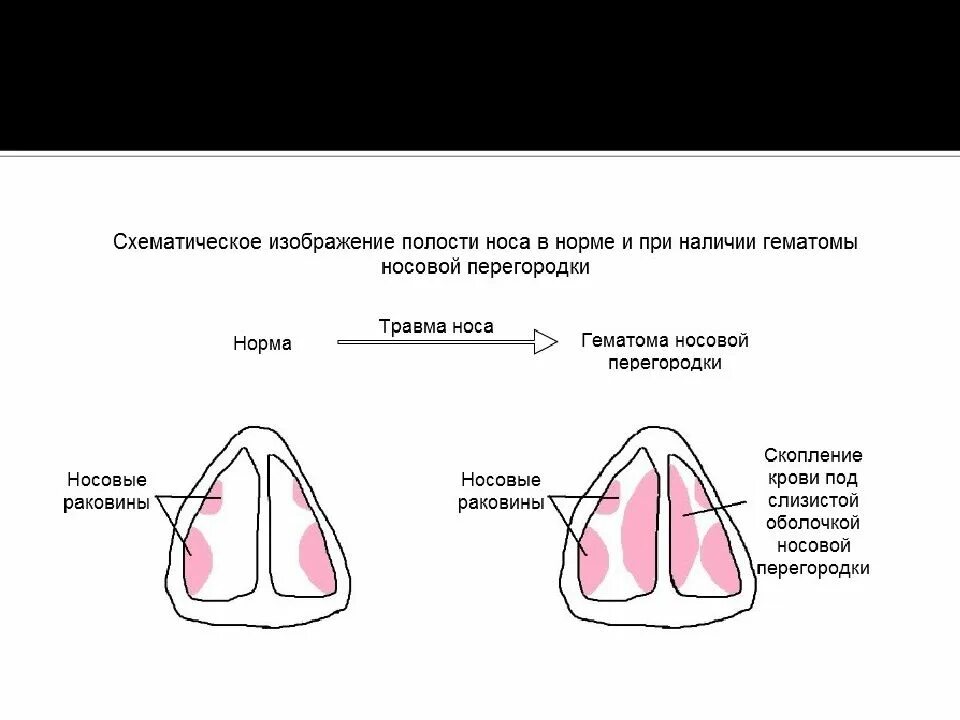 Схема вскрытия абсцесса перегородки носа. Гематома внутренней перегородки носа. Строение перегородки носа. Носовая перегородка код по мкб 10