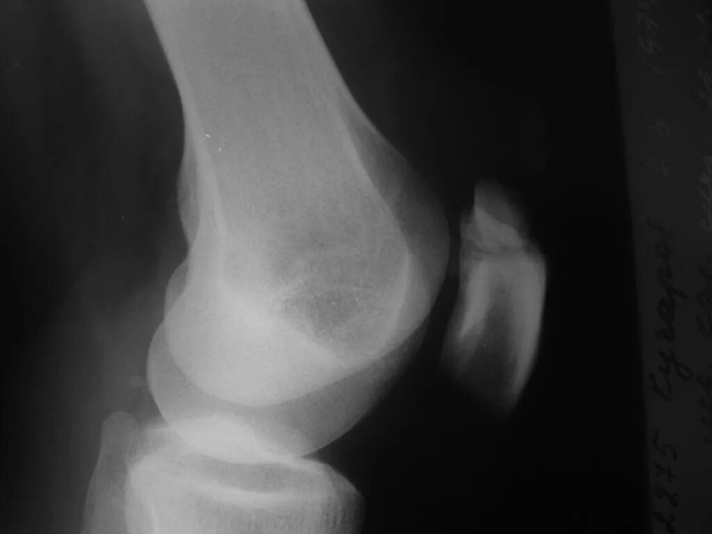 Трещина в коленной. Перелом надколенника rentgen. Рентген колена перелом надколенника. Перелом надколенника рентген. Перелом чашечки коленного сустава рентген.