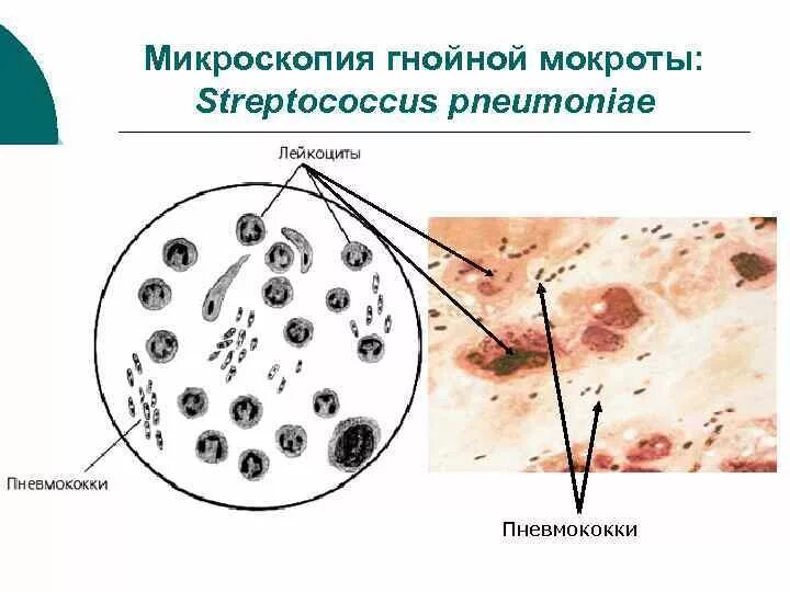 Мокрота нативный препарат микроскопия. Микроскопия мокроты при пневмонии. Мерцательный эпителий в мокроте микроскопия. Микроскопия гнойной мокроты.