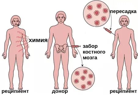 Трансплантация стволовых клеток костного мозга. Трансплантация гемопоэтических стволовых клеток. Трансплантация аллогенных клеток. Трансплантация гемопоэтических стволовых клеток у детей.