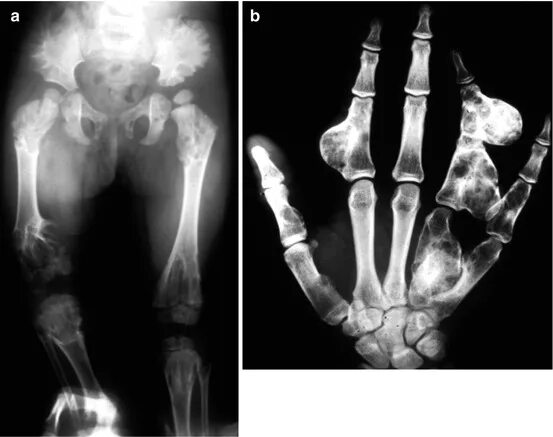 Дисхондроплазия - болезнь Оллье. Хондроматоз костей (болезнь Оллье). Хондроматоз костей (дисхондроплазия).