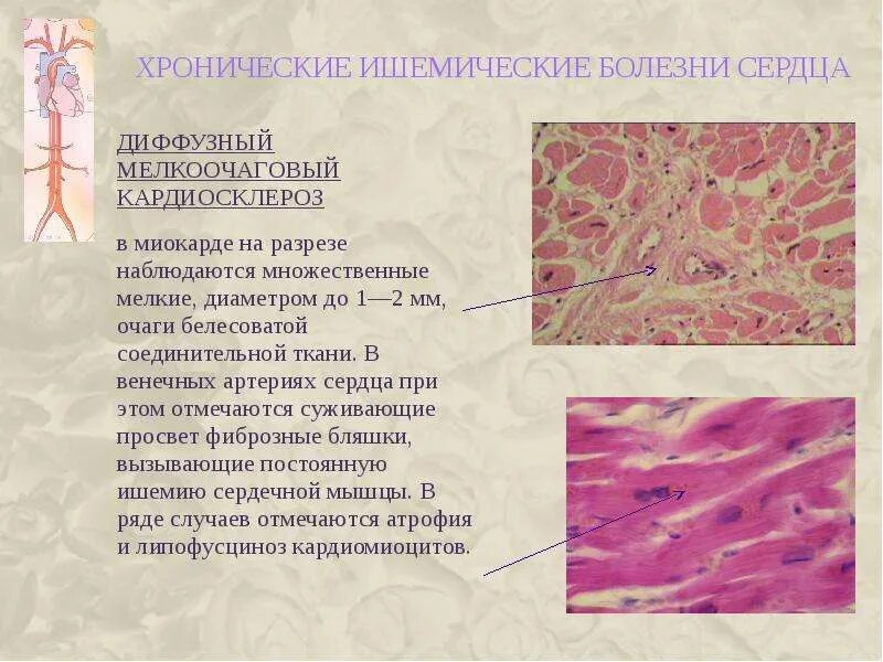Ибс диффузный кардиосклероз. Ибс диффузный кардиосклероз