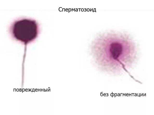 Днк спермограмма сдать. Спермограмма с днк фрагментацией. фрагментация днк сперматозоидов. тест на фрагментацию сперматозоидов.. днк-фрагментация сперматозоидов в картинках.
