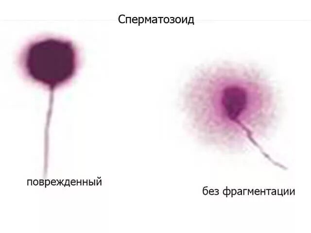 Днк методом tunel. Спермограмма с ДНК фрагментацией. Фрагментация сперматозоидов 17. Фрагментация ДНК сперматозоидов. ДНК-фрагментация сперматозоидов в картинках.