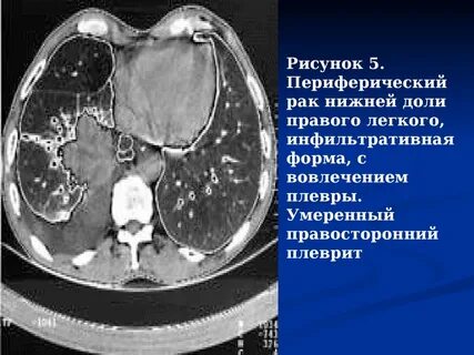Полость в легком