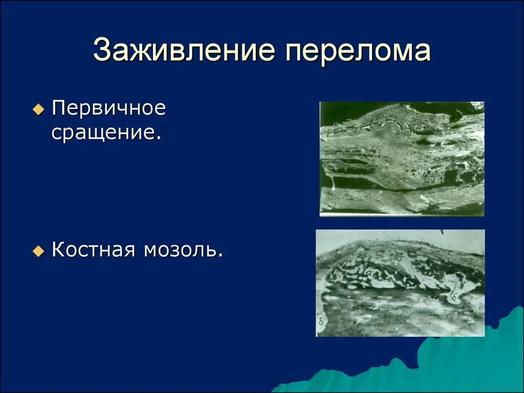 Трещина заживает. Первичное заживление перелома. Первичное и вторичное заживление переломов. Первичное и вторичное заживление кости. Механизм и виды заживления перелома.