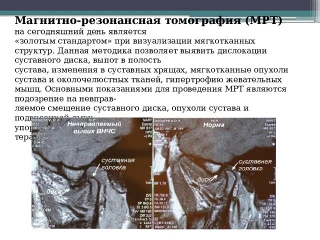 Дислокация суставного диска с репозицией. Дислокация суставного диска с репозицией