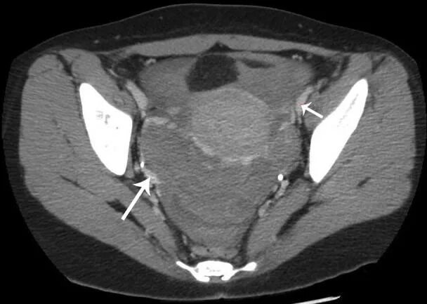 Свободная жидкость в малом тазу на узи. Жидкость в малом тазу на узи. Лимфоциты в плевральной жидкости. Жидкость малого таза при узи матки. Выпот в тазу.