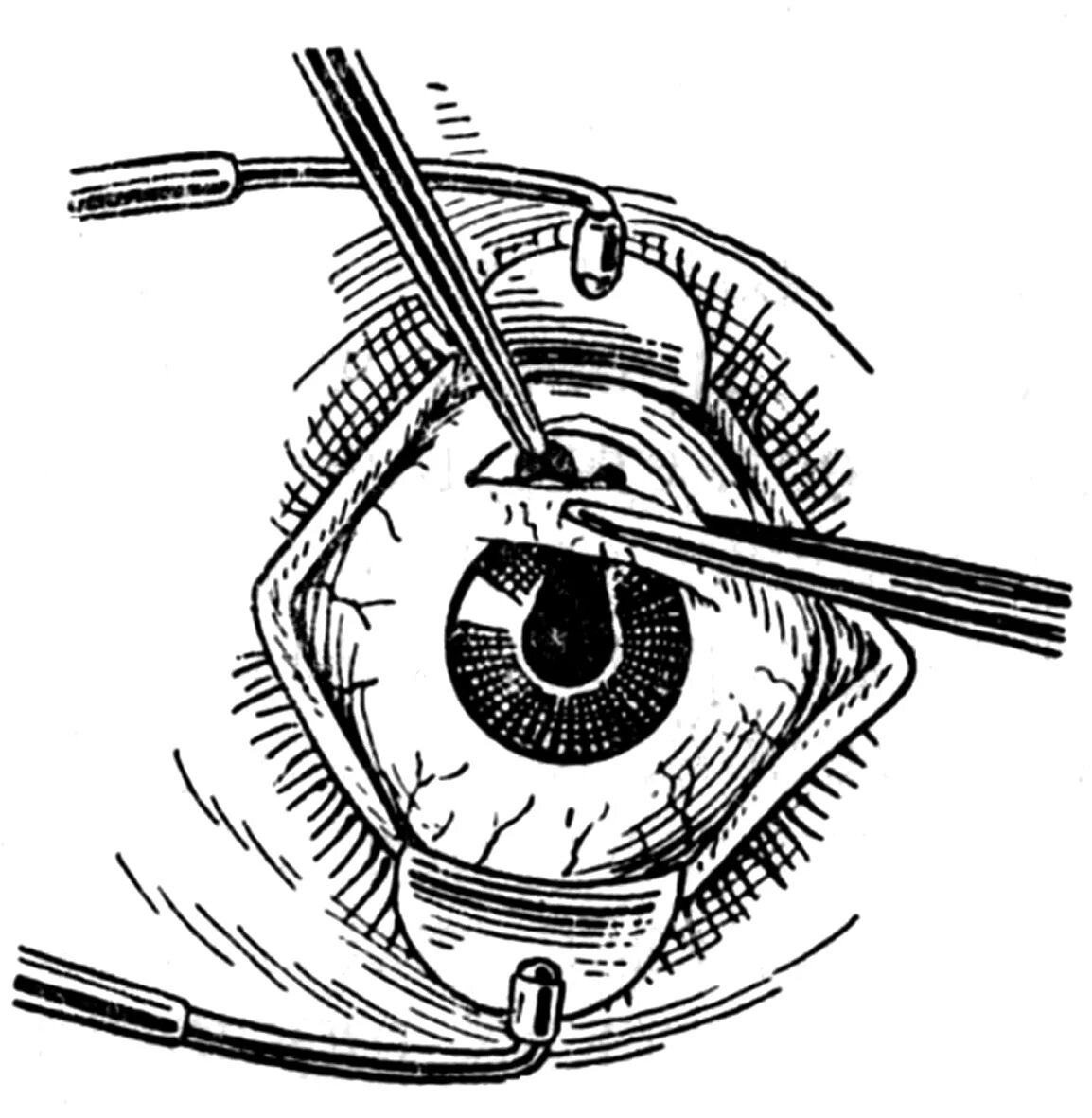 Больница операция глаукомы. Задняя Трепанация склеры. Операция глаукома синустрабекулэктомия. Операция дренаж глаукома. Задняя Трепанация склеры техника.
