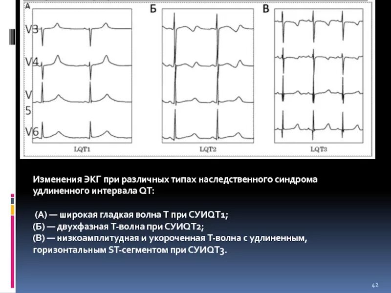 Удлиненное qt у ребенка. Синдром удлиненного интервала qt на ЭКГ. ЭКГ при синдроме CLC. Синдром Бругада 1 типа на ЭКГ. Синдром Бругада синдром удлиненного интервала qt.