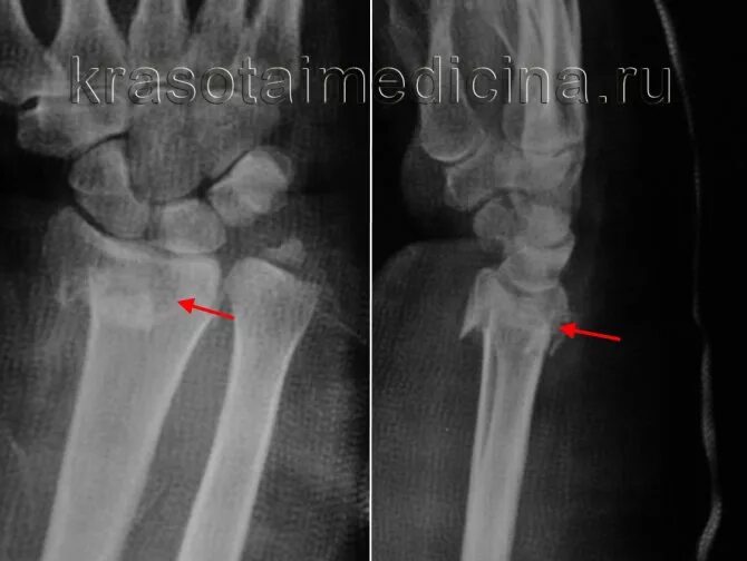 Перелом диафиза лучевой кости рентген. Разгибательный перелом луча в типичном месте рентген. Винтообразный перелом лучевой кости. Перелом руки лучевой кости в дистальной трети.