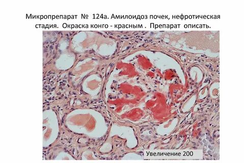 Амилоидоз рисунок