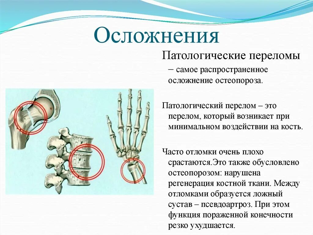 Осложнения при открытых переломах. Переломы костей при остеопорозе. Осложнения остеопороза. Осложнения деформирующего остеопороза. Патологический перелом при остеопорозе.