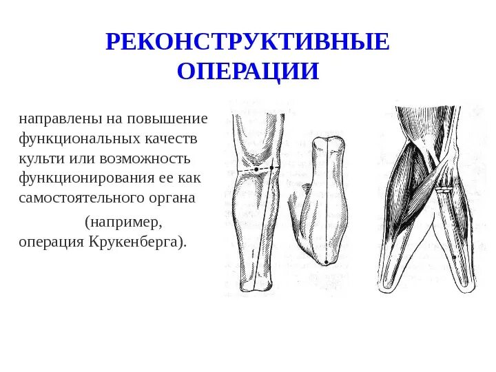 Ампутация Крукенберга Альбрехта. Операция Крукенберга Альбрехта. Культи предплечья по Крукенбергу.