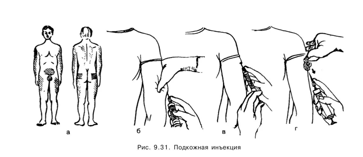 Инъекция подкожно в плечо алгоритм. Внутрикожная инъекция техника выполнения в плечо. Укол подкожно в плечо техника. Внутримышечная инъекция в плечо алгоритм. Подкожные инъекции техника выполнения