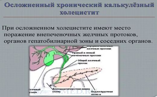 Препараты при загибе желчного пузыря. Изгиб желчного протока. массаж желчных протоков. желчегонные средства при холецистите. желчегонные препараты при перегибе желчевыводящих путей.