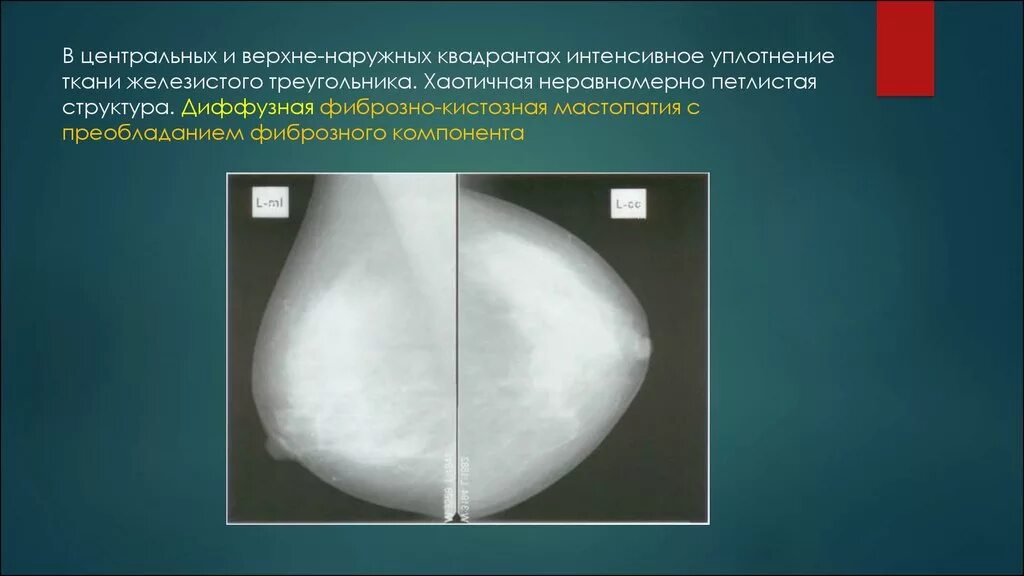 Диффузно фиброзно кистозная изменения