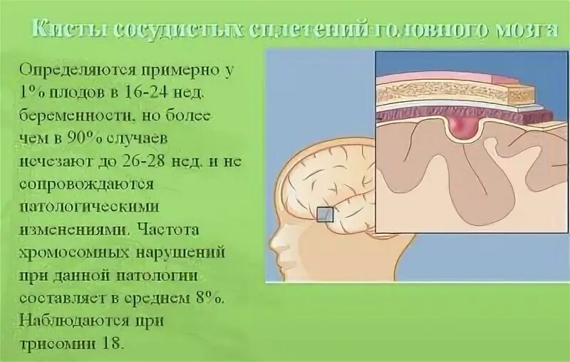 Кисты сосудистых сплетений головного мозга у плода. Киста сосудистого сплетения у плода. Киста сосудистого сплетения УЗИ. Киста сосудистого сплетения головного мозга у новорожденного.