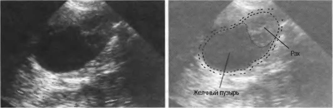 Диффузное утолщение стенок. Объемное образование желчного пузыря УЗИ. Трансабдоминальная ультрасонография желчного пузыря. УЗД опухолей желчного пузыря. Аденома желчного пузыря УЗД.