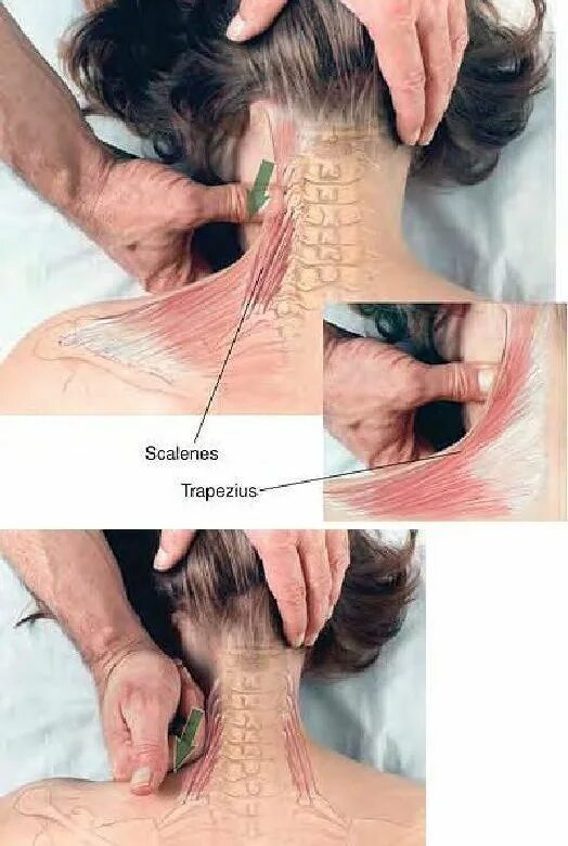 Игнатьев самомассаж шеи. Триггерные точки шейного отдела позвоночника. Массаж шейно-воротниковой зоны при остеохондрозе. Массаж шейно-грудного отдела. Массаж шейного отдела позвоночника.