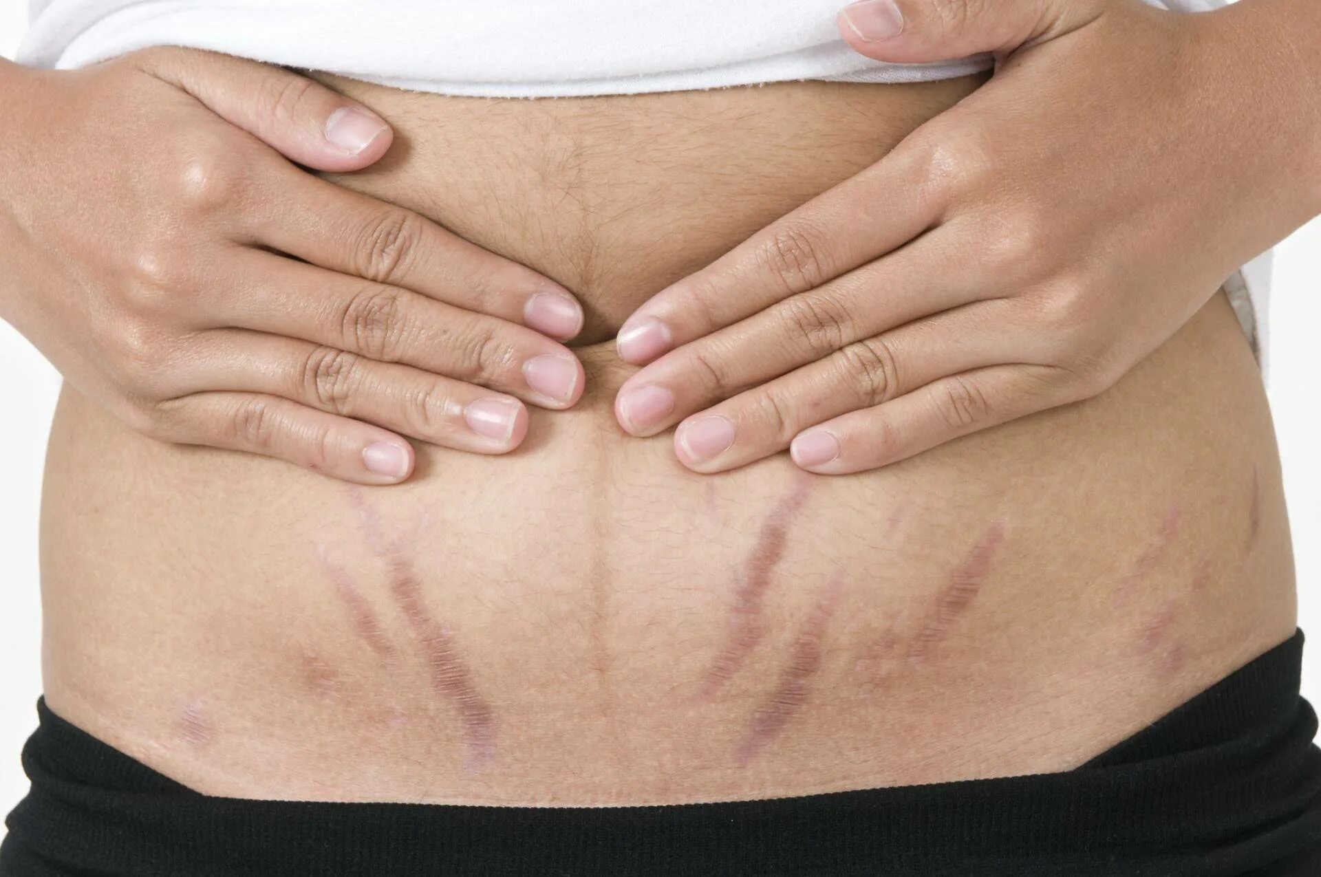 Растяжки stretch marks. Растяжки stretch marks