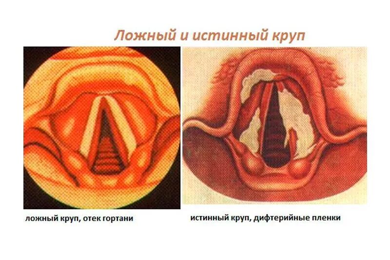 Стенозирующий ларингит ложный круп. Дифтерийный круп и ложный круп. Ложный круп. Острый стенозирующий ларинготрахеит..