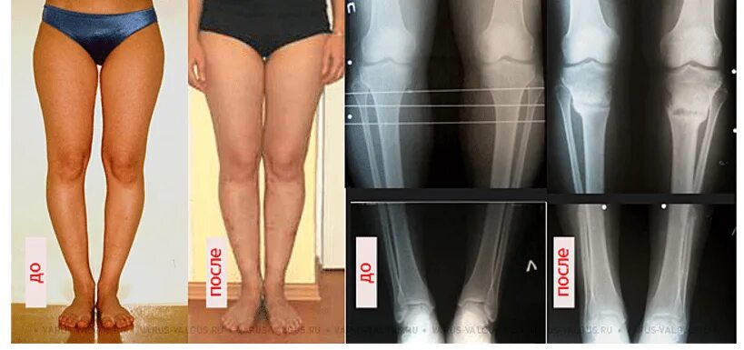 Вальгусная стопа у взрослых операция. Варус вальгусная деформация. Варусная и вальгусная деформация коленного сустава. Варусная деформация коленных суставов. Вальгус и Варус коленных суставов.