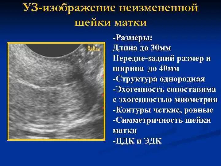 Эндометрий 3 мм. Размер тела матки норма по УЗИ мм. Эхогенность миометрия. Размеры шейки матки на УЗИ норма. Нормальные параметры матки.