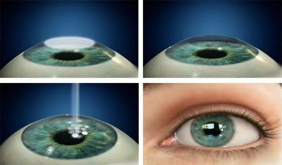 Сколько восстанавливается зрение после лазерной. Метод ФРК лазерная коррекция. Кератоконус кросслинкинг. Коррекция зрения по технологии ФРК (фоторефракционная кератэктомия). Лазерная коррекция зрения методом ласик.