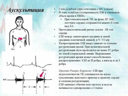 Шумы у левого края грудины