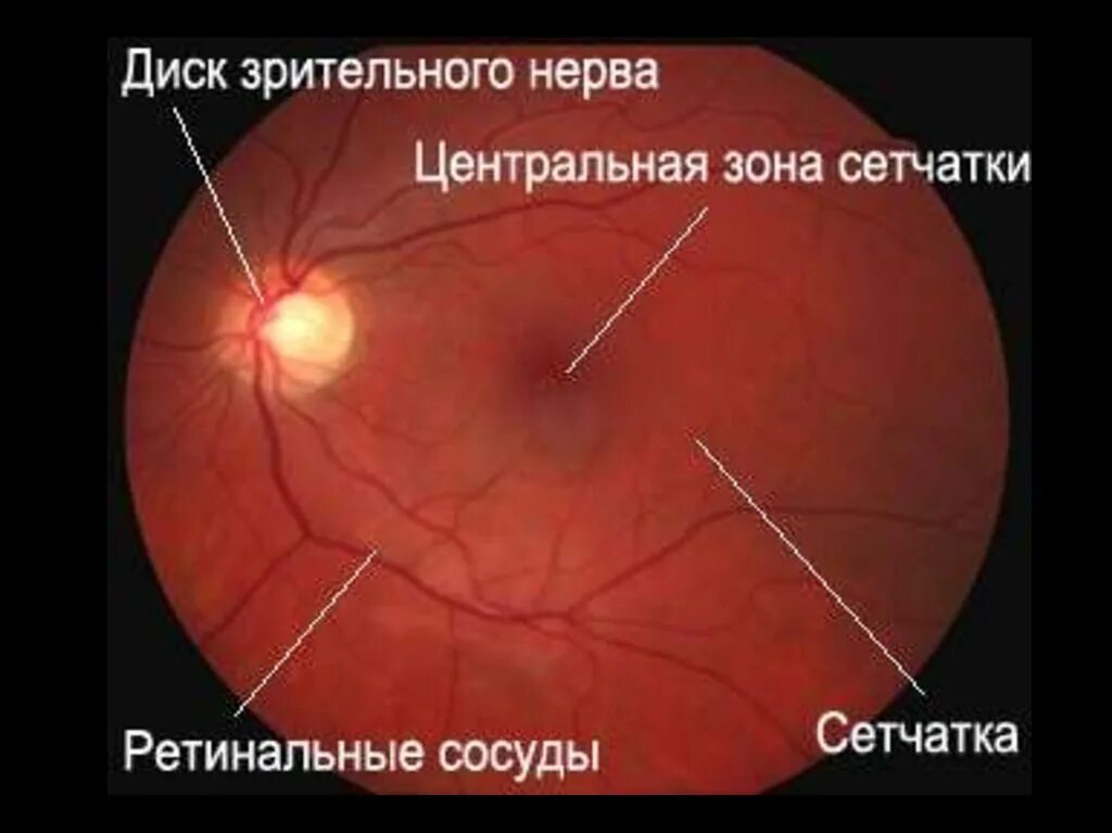 Норма зрительного нерва. Офтальмоскопия глазного дна норма. Зрительный нерв глазное дно норма. Глазное дно при офтальмоскопии норма. Диск зрительного нерва в норме.