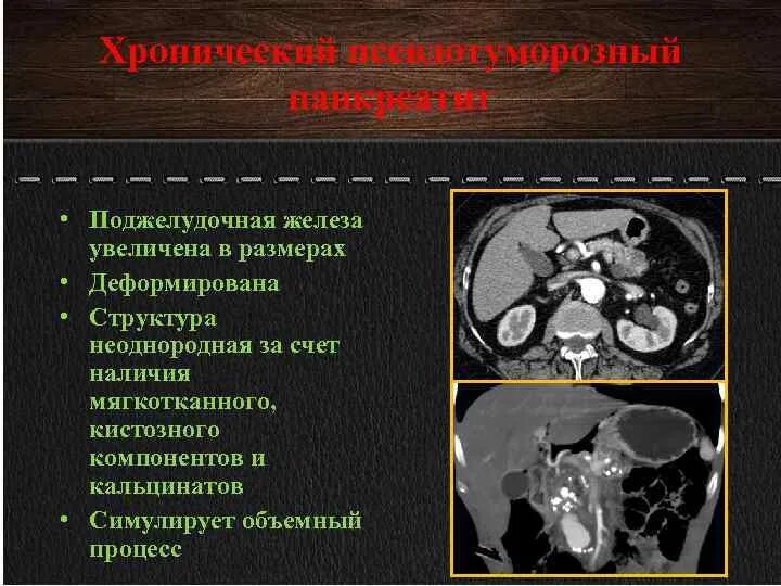 Неоднородные изменения поджелудочной железы. Псевдотуморозный панкреатит головки поджелудочной железы кт. Псевдотуморозный панкреатит на кт. Псевдотуморозная форма хронического панкреатита. Кт признаки хронического панкреатита.