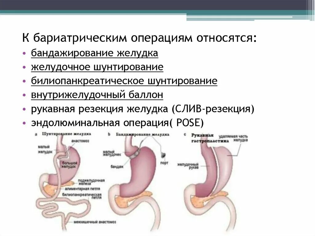 Бариатрическая хирургия это. Операция на желудке бариатрическая операция. Продольная резекция желудка для похудения. Лапароскопическая продольная резекция желудка.